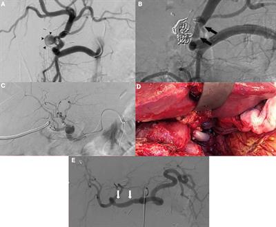 Case report: Immediate revascularization for symptomatic hepatic artery pseudoaneurysm after orthotopic liver transplantation? A case series and literature review